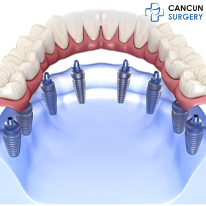 All-on-8 Dental Implants