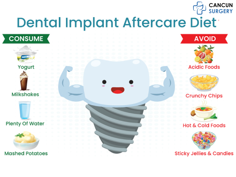 Full Mouth Dental Implants in Cancun