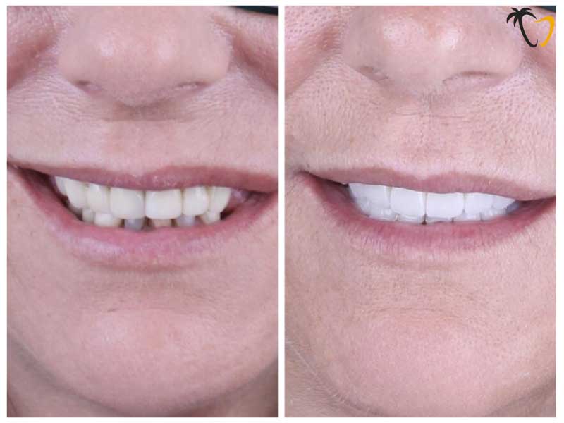 Tatjana Hatten, Alabama, US - Before & After Titanium Dental Implants