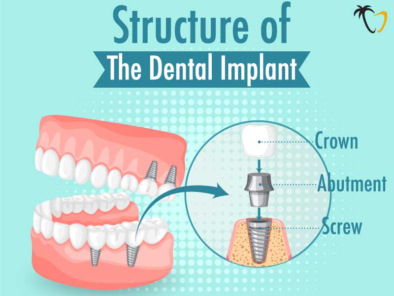 Dental Implants in Cancun: Structure