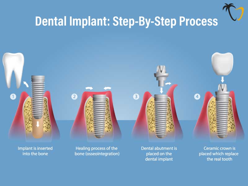 Dental Implant Complete Procedural Breakdown