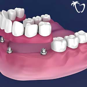 All-on-4 Dental Implants in Cancun