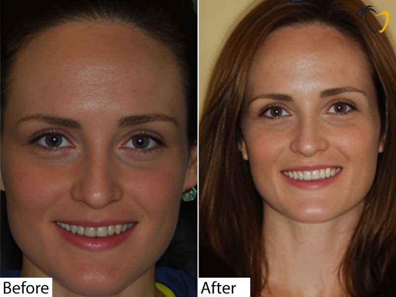 Cosmetic Dentistry in Cancun | Before & After Cosmetic Smile in Cancun