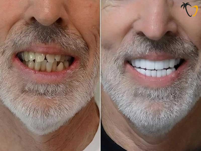 Full Mouth Restoration in Cancun: Before & After