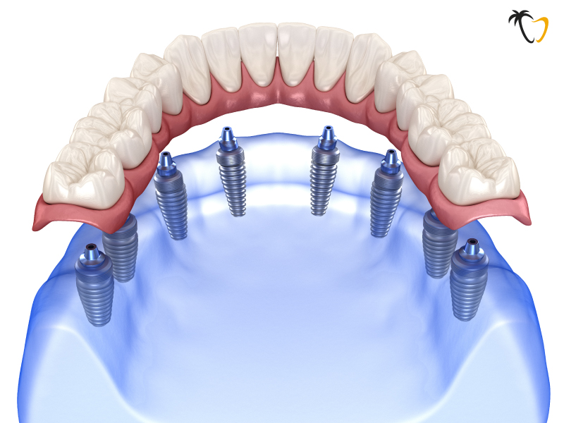 All on 8 Dental Implants in Cancun