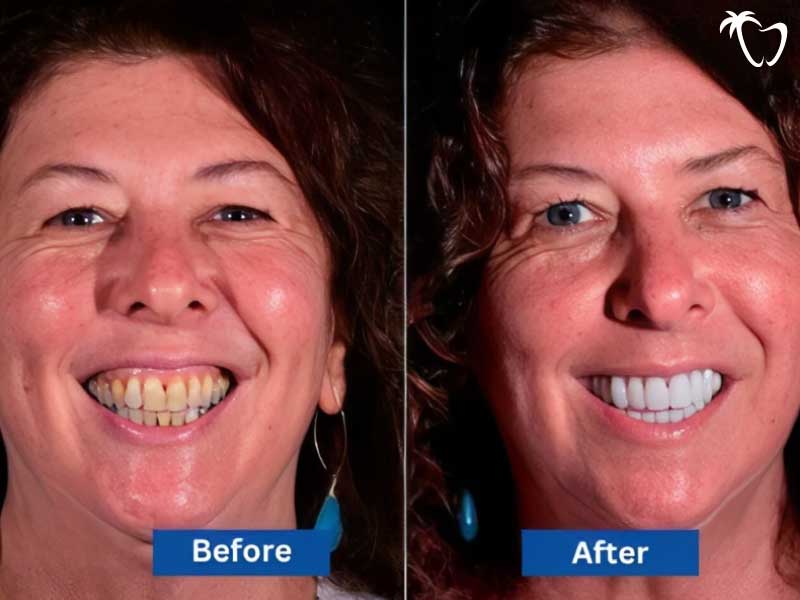 Before & After Emax Crowns in Cancun