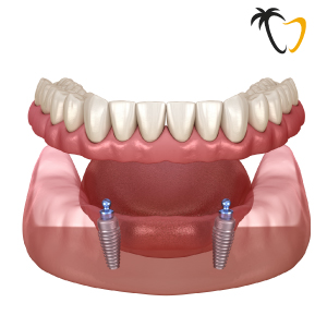 Overdenture in Cancun