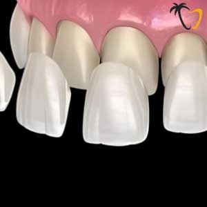 Porcelain Veneers