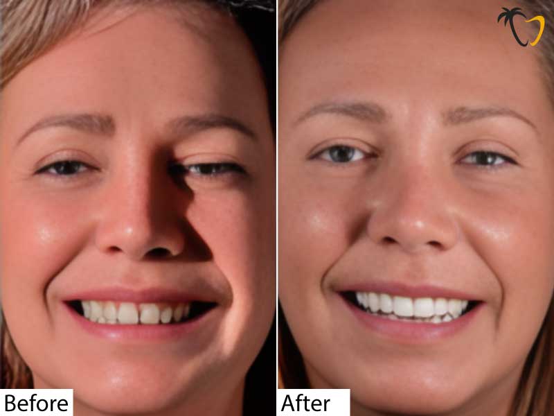 Cosmetic Dentistry in Cancun | Before & After: Dental Veneers